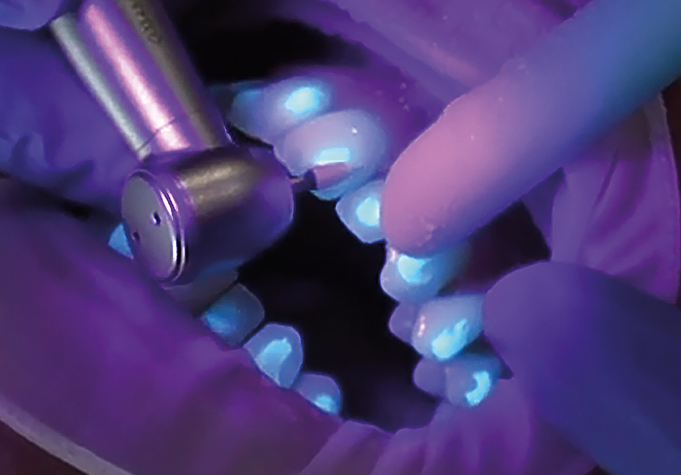 Aligner Flow LC - Syringe - Image 2
